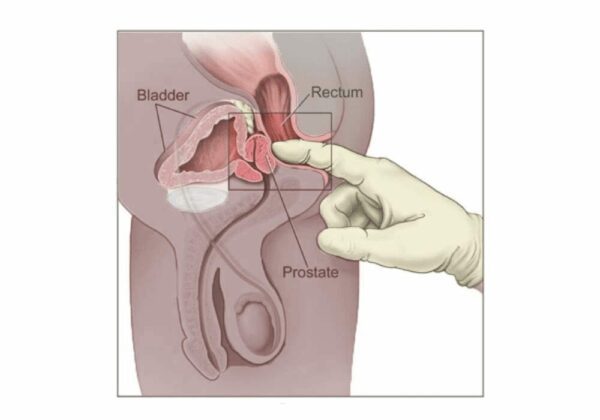 Digital-Rectal-Exam-DRE