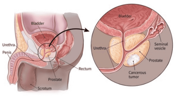 What-is-prostate-cancer